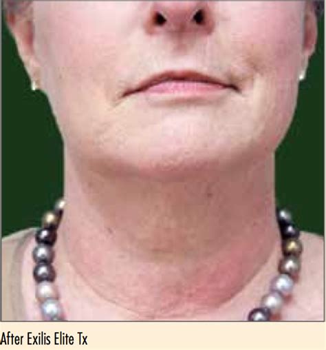 Perfect Body Laser And Aesthetics Non Surgical Neck Lift