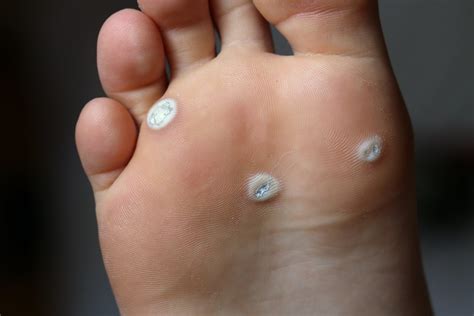 Hpv On Foot Top Sellers Emergencydentistry