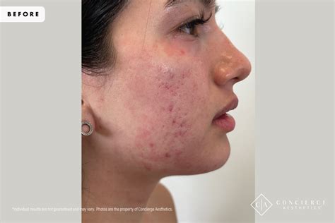 B A Morpheus8 Acne Scarring