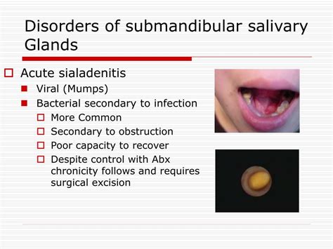 Ppt Salivary Glands Disorders Powerpoint Presentation Free Download