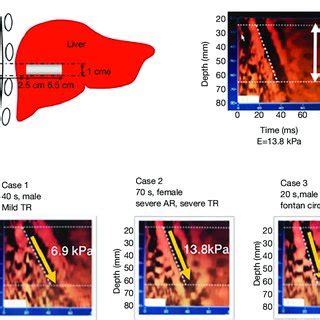 Liver stiffness by FibroScan ® . (A) Panels show how to measure liver ...