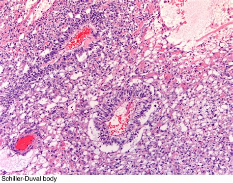 Merkel Cell Tumour Pathology Outlines Pathology Outlines Basal Cell