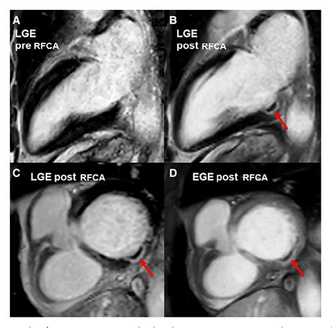 Figure From Characteristics Of The Ablation Lesions In Cardiac