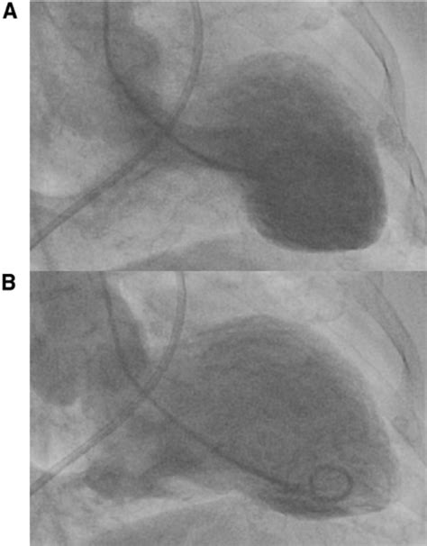 Hemodynamic Findings During Cardiac Catheterization Showing Severe Download Scientific Diagram