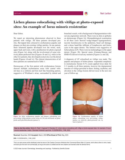 PDF Lichen Planus Colocalising With Vitiligo At Photo Exposed Sites