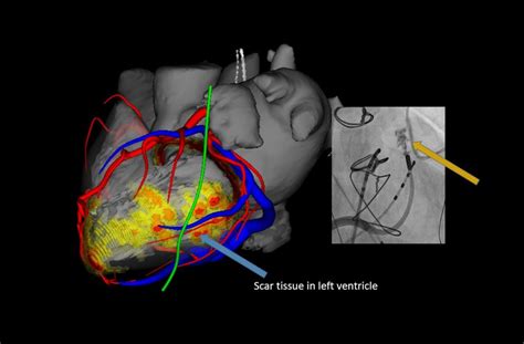 VT Ablation With Investigational Needle Catheter Shows Promise In