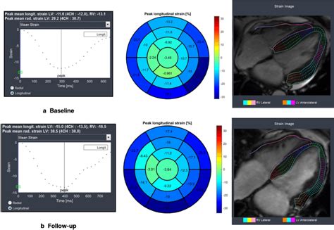 Example Of Global Longitudinal Strain By Ft Cmr In A Year Old Man