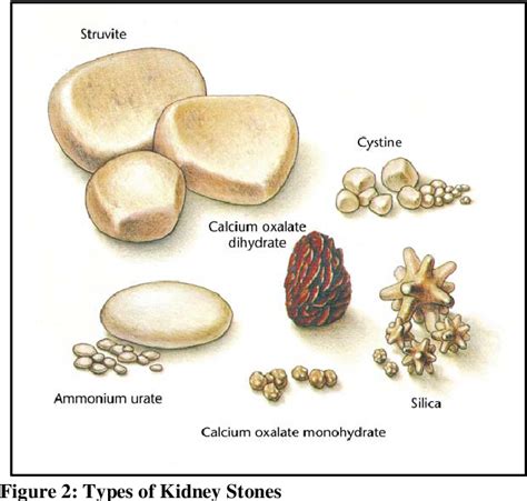 Urolithiasis An Overview Semantic Scholar