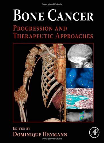 SECONDARY BONE CANCER PROGNOSIS | SECONDARY BONE CANCER PROGNOSIS