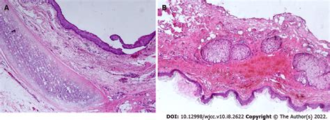 Histopathological analysis of the teratoma. A and B: The cyst wall was ...