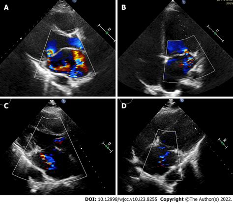 Mitral valve assessment by transthoracic echocardiography. A and B:... | Download Scientific Diagram