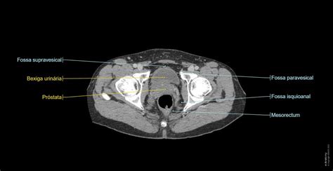 Ressonância Magnética De Bacia Pelve Abdômen Inferior