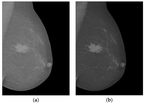 Applied Sciences Free Full Text TTCNN A Breast Cancer Detection