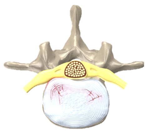 Discopathie Lombaire Symptômes Et Options De Traitement