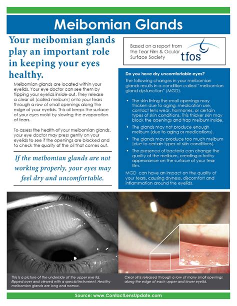 Patient Handout: Meibomian gland dysfunction | Contact Lens Update