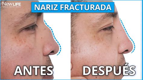 Incre Ble Cambio De Nariz Fracturada Correcci N De Nariz Sin