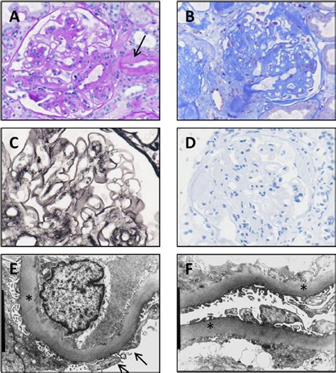 Histological Evaluation Of The Kidney Biopsy A Kidney Biopsy