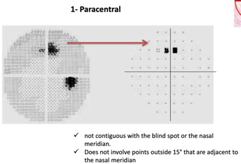 Humphrey Glaucoma Visual Field Defects Flashcards Quizlet