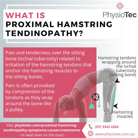 Proximal Hamstring Tendinopathy Symptoms Causes Treatments