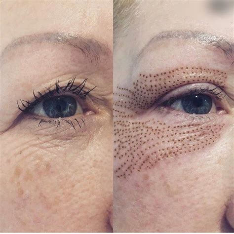 How Can You Tighten Eyelids Without Surgery Best Treatment Available