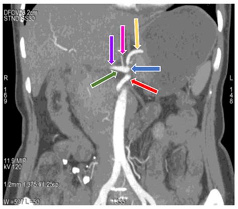 Diagnostics Free Full Text Unraveling Variations In Celiac Trunk