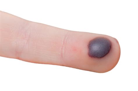 Blood Blisters Causes How To Heal And Prevention