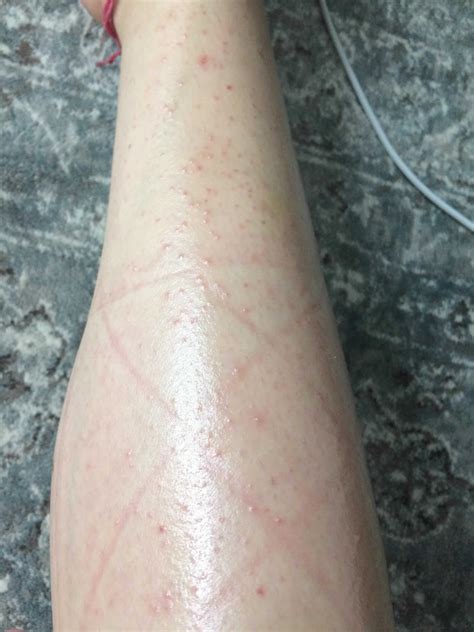 Hair Follicle Infection Not Going Away at Callum Winter-irving blog