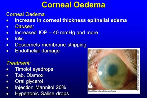 Causes Of Corneal Edema