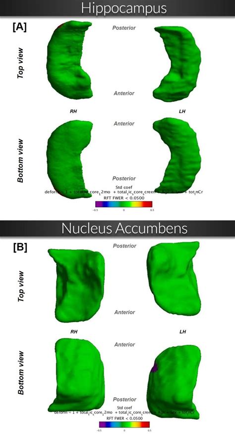 Subcortical Local Shape Deformation And Total Tic Score Symptom