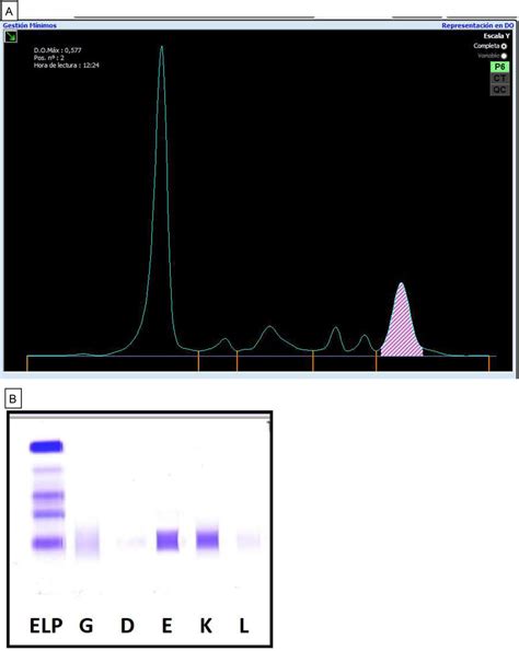 Serum protein test of the patient. (A) Serum proteinogram (Capillarys-2 ...