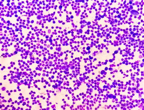 Synovial Fluid Cytology, Plenty WBC, microscopic examination of