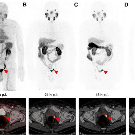 Maximum Intensity Projections MIP And Transversal PET CT Slices Of