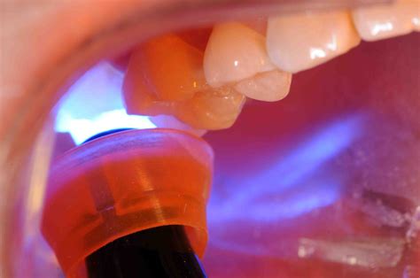 Light Curing Tip Placement and Curing Effectiveness - Lee Ann Brady DMD