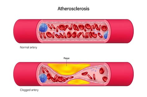 normal artery  clogged artery vector cardiovascular disease coronary