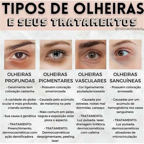 Qual O Melhor Tratamento Para Olheiras