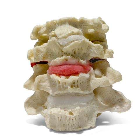 Determining a Painful Disc: Sub-Type Diagnosis Approach