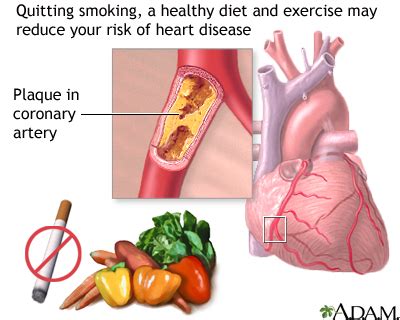 Atherosclerosis Hardening Of The Arteries Natural Treatment And