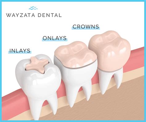 Dental Inlays Vs. Onlays: Do You Need Them? (Pros & Cons)