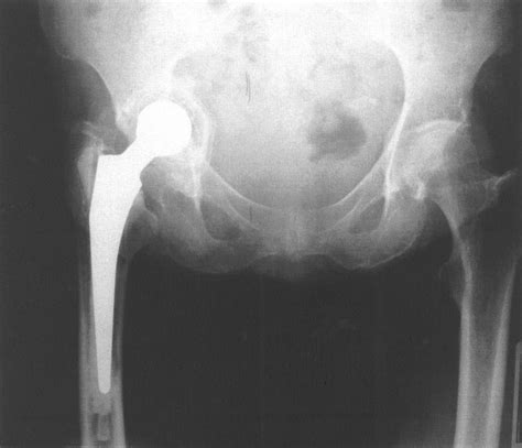 Year Old Woman Protrusio Acetabuli Hip Replaced In With