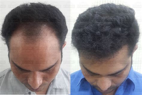 Prime Hair Studio & Cosmetic Clinic : Hair Transplant Cost in Mumbai