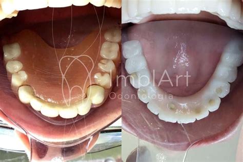 Prótese total sobre implantes com céu da boca livre ImplArt