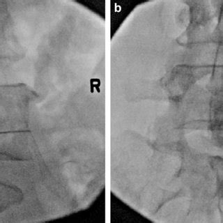 Superior hypogastric plexus block. a Lateral fluoroscopic view, needle... | Download Scientific ...