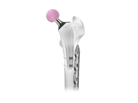 stretto cable system globus medical