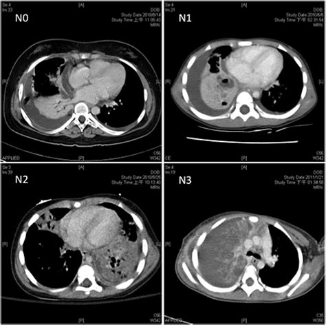 Necrotizing Pneumonia Radiology