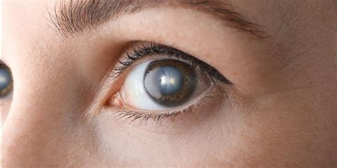 Understanding The Impact Of Cataracts And Night Vision Clearsight