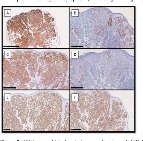 Figure From Endocrine Mucin Producing Sweat Gland Carcinoma Case