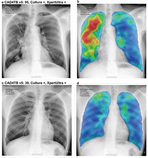 Deep Learning Classification Of Active Tuberculosis Lung 57 Off