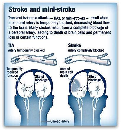 TIA Transient Ischemic Attack / Stroke CVA / Types of brain injury