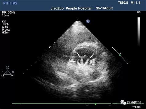 心脏人工瓣膜：有些超声知识点和你想象的不一样二尖瓣