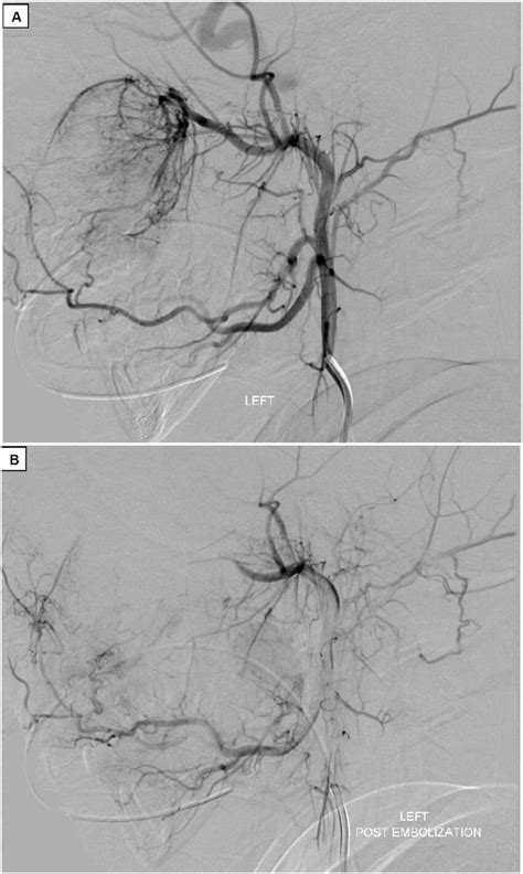 Pre And Post Embolization Of The Maxillary Artery Preliminary External Download Scientific